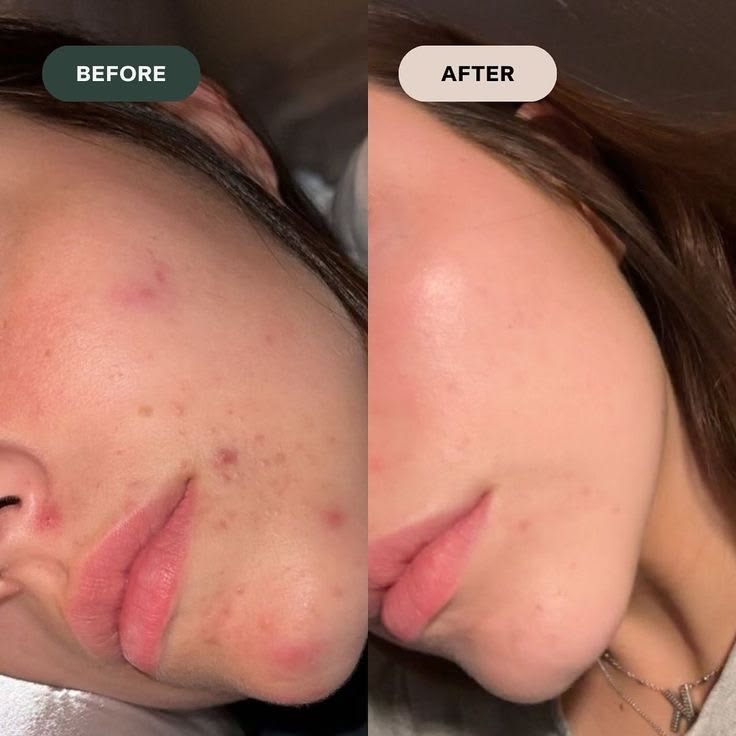GlowLift LED Mask